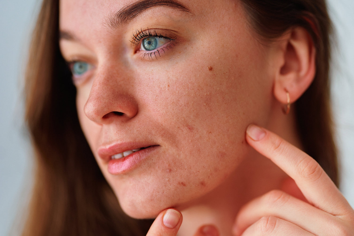 Understanding Acne: Causes, Treatment, and Prevention